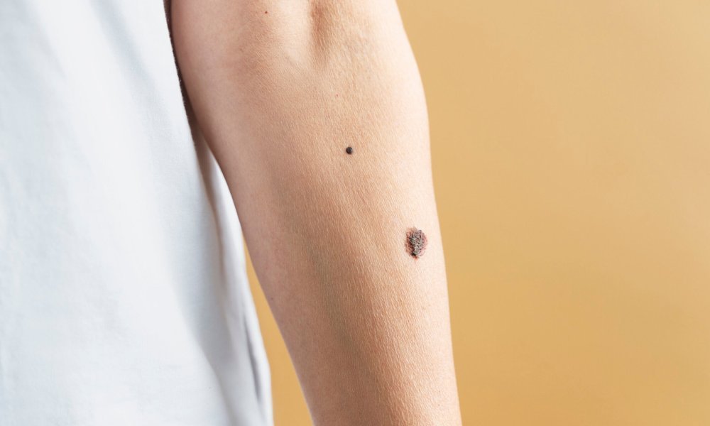 close-up-hand-with-different-size-moles